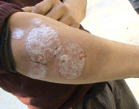 怎么样治神经性皮炎,专家自有绝招