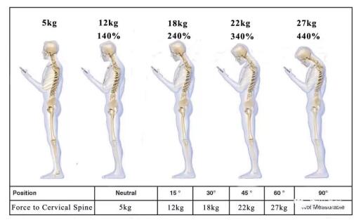 长期低头致"c"型颈椎弯曲变形